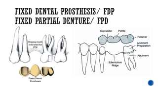 Missing tooth
indicated for
FDP
Fixed Dental
Prosthesis
 