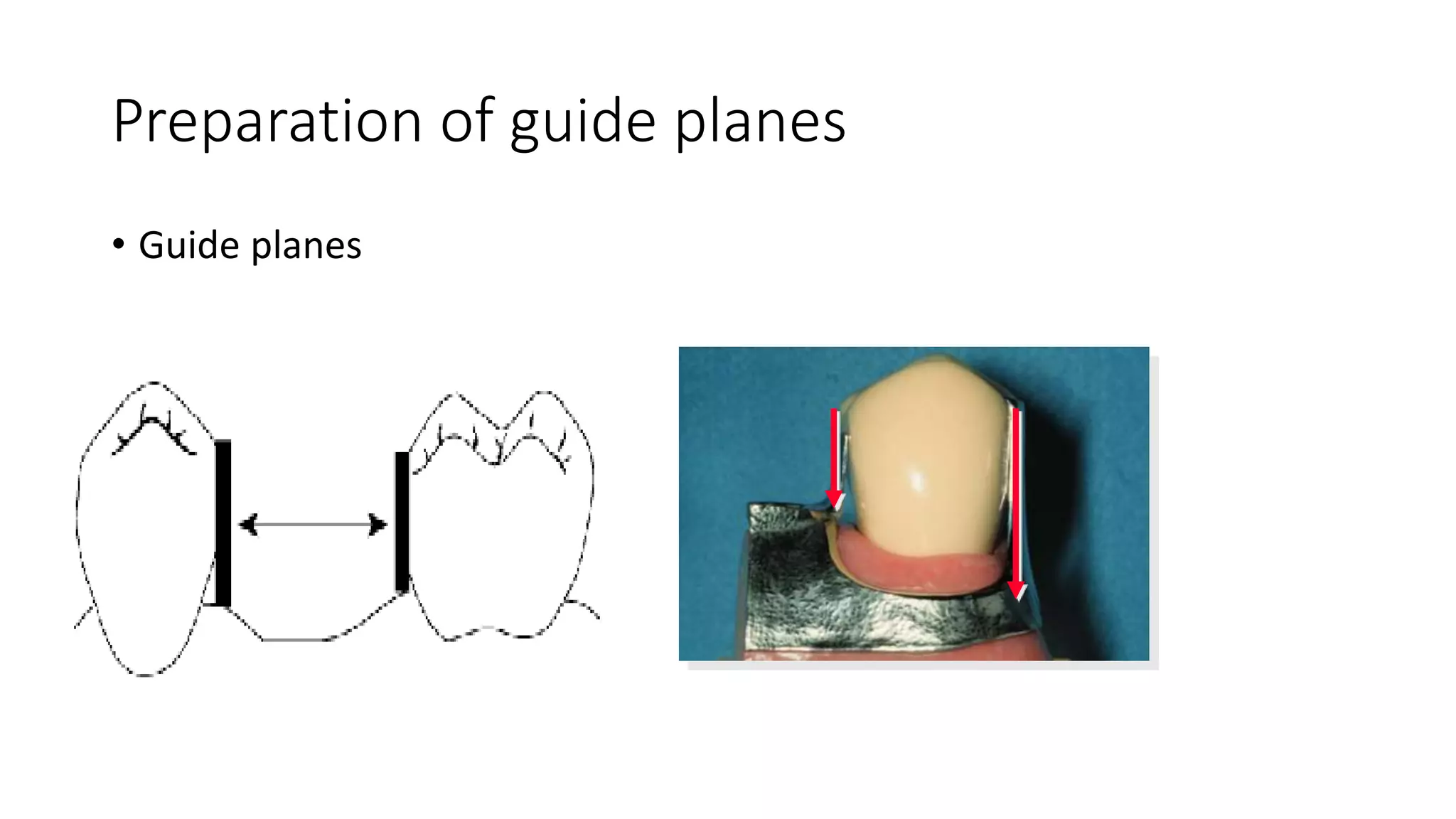 ABUTMENT TOOTH PREPARATION.pptx