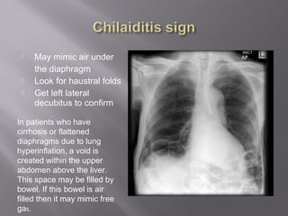  May mimic air under
the diaphragm
 Look for haustral folds
 Get left lateral
decubitus to confirm
In patients who have
cirrhosis or flattened
diaphragms due to lung
hyperinflation, a void is
created within the upper
abdomen above the liver.
This space may be filled by
bowel. If this bowel is air
filled then it may mimic free
gas.
 