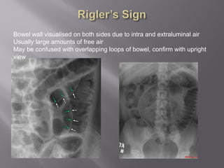 Bowel wall visualised on both sides due to intra and extraluminal air
Usually large amounts of free air
May be confused with overlapping loops of bowel, confirm with upright
view
 