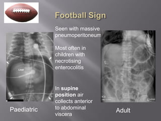Seen with massive
pneumoperitoneum
Most often in
children with
necrotising
enterocolitis
Paediatric Adult
In supine
position air
collects anterior
to abdominal
viscera
 