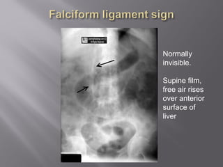 Normally
invisible.
Supine film,
free air rises
over anterior
surface of
liver
 