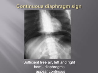 Sufficient free air, left and right
hemi- diaphragms
appear continous
 