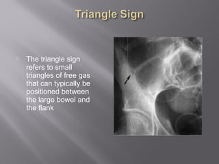  The triangle sign
refers to small
triangles of free gas
that can typically be
positioned between
the large bowel and
the flank
 
