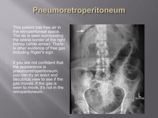  This patient has free air in
the retroperitoneal space.
The air is seen surrounding
the lateral border of the right
kidney (white arrow). There
is other evidence of free gas
including Rigler's sign.
 If you are not confident that
the appearance is
pneumoretroperitoneum,
you can try an erect and
decubitus view to see if the
gas moves. If the gas is
seen to move, it's not in the
retroperitoneum.
 
