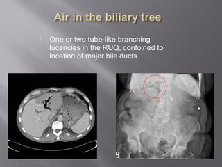  One or two tube-like branching
lucencies in the RUQ, confoined to
location of major bile ducts
 
