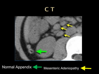 Normal Appendix Mesenteric Adeniopathy
 