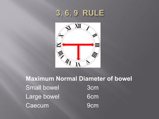 Maximum Normal Diameter of bowel
Small bowel 3cm
Large bowel 6cm
Caecum 9cm
 