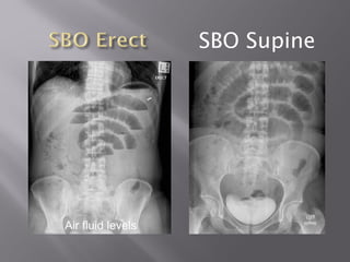 SBO Supine
Air fluid levels
 
