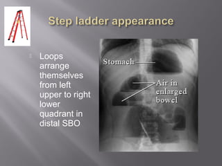  Loops
arrange
themselves
from left
upper to right
lower
quadrant in
distal SBO
 