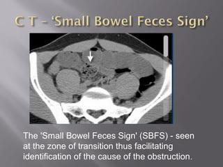 The 'Small Bowel Feces Sign' (SBFS) - seen
at the zone of transition thus facilitating
identification of the cause of the obstruction.
 