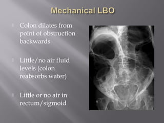  Colon dilates from
point of obstruction
backwards
 Little/no air fluid
levels (colon
reabsorbs water)
 Little or no air in
rectum/sigmoid
 