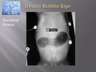 Duodenal
Atresia
 