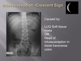 Caused by:
LUQ Soft tissue
mass
OR
Head of
intussusception in
distal transverse
colon
 