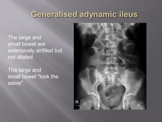 The large and
small bowel are
extensively airfilled but
not dilated.
The large and
small bowel "look the
same".
 