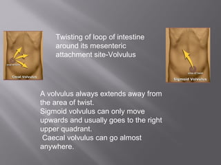 A volvulus always extends away from
the area of twist.
Sigmoid volvulus can only move
upwards and usually goes to the right
upper quadrant.
Caecal volvulus can go almost
anywhere.
Twisting of loop of intestine
around its mesenteric
attachment site-Volvulus
 