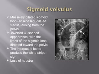  Massively dilated sigmoid
loop (an air-filled, dilated
viscus) arising from the
pelvis
 inverted U -shaped
appearance, with the
limbs of the sigmoid loop
directed toward the pelvis
 The interposed loops
produce the white-stripe
sign
 Loss of haustra
 