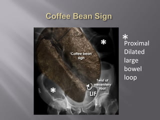 Proximal
Dilated
large
bowel
loop
*
 