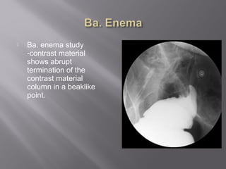  Ba. enema study
-contrast material
shows abrupt
termination of the
contrast material
column in a beaklike
point.
 