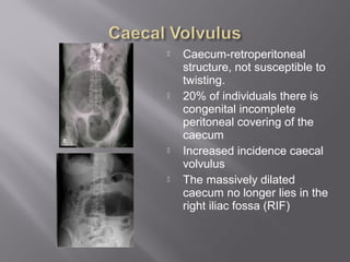  Caecum-retroperitoneal
structure, not susceptible to
twisting.
 20% of individuals there is
congenital incomplete
peritoneal covering of the
caecum
 Increased incidence caecal
volvulus
 The massively dilated
caecum no longer lies in the
right iliac fossa (RIF)
 