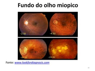 Fundo do olho miopico
Fonte: www.lookfordiagnosis.com
18
 