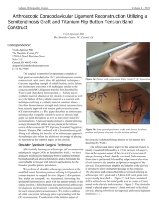 Indiana Orthopaedic Journal Volume 4 – 2010 The surgical treatment of symptomatic complete or high grade acromioclavicular (AC) joint disruptions remains controversial  with  more  than  60  published  techniques. 1 Concerns regarding strength of initial fixation, cyclic failure, and inconsistent outcomes with techniques similar to the coracoacromial (CA) ligament transfer first described by Weaver and Dunn have been reported. 2-5  Failure due to synthetic material abrasion at the clavicle or coracoid as well as cyclic failure of the synthetic material is a concern with techniques utilizing a synthetic material construct alone. 6,  7 Excellent biomechanical strength and clinical outcomes have been recently reported with tendon graft coracoclavicular (CC) reconstruction. 8-10  This paper describes an arthroscopic technique that is equally suitable to acute or chronic high grade AC joint disruptions as well as previously failed CC reconstructions. A tension band construct is created utilizing a single titanium ﬂip button device placed at the inferior cortex of the coracoid (#7 PE ZipLoop Extended ToggleLoc; Biomet. Warsaw, IN) combined with a Semitendinosis graft. Along with offering the benefits of an arthroscopic approach, the technique also offers the additional advantage of placing no hardware at the superior aspect of the clavicle. Shoulder Specialist  Surgical Technique After initially learning an arthroscopic AC reconstruction technique in August 2000, as described by Wolf, 11  we have gradually modified our technique both to address potential biomechanical and clinical limitations and to formulate the most reliable technique with inherent applicability for the broadest possible patient population. We perform all shoulder arthroscopy procedures in the modified lateral decubitus position utilizing 6-10 pounds of counter-traction to suspend the arm. (Figure 1) For patients that  prefer  an  autograft,  we  recommend  harvesting  the ipsilateral Semitendinosis graft with the patient initially in the supine position. 12  Glenohumeral and subacromial arthroscopy for diagnosis and treatment is initially performed as required for each unique patient circumstance. We prefer to address all other concurrent pathology prior to proceeding with the CC reconstruction. Visualization of the inferior aspect of 79 Arthroscopic Coracoclavicular Ligament Reconstruction Utilizing a Semitendinosis Graft and Titanium Flip Button Tension Band Construct Vivek Agrawal, MD The Shoulder Center, PC, Carmel, IN Correspondence: Vivek Agrawal MD The Shoulder Center, PC 12188-A North Meridian Street Suite 310 Carmel, IN 46032-4406 [email_address] (317) 802-9686 Figure 1a:  Patient with symptomatic Right Grade IV AC Separation. Figure 1b:  Same patient positioned in the semi-lateral decubitus position with portal sites and clavicle incision outlined. the coracoid is then performed similar to the manner first described by Wolf. 11 The inferior and lateral aspect of the coracoid process is clearly visualized followed by a 1.5cm incision in Langer’s lines at the superior aspect of the clavicle (3cm incision if also performing a distal clavicle resection). Subcutaneous dissection is performed followed by subperiosteal elevation of soft tissues to the anterior and posterior margins of the clavicle. The periosteum anterior and inferior to the clavicle is elevated to allow instrument passage to the coracoid. The clavicular and coracoid tunnels are created utilizing an arthroscopic ACL guide and a 2.4mm drill point guide wire as previously described. 11  (Figure 2) A 4.5mm cannulated drill is utilized over the initial guide wire to create a 4.5mm tunnel in the clavicle and coracoids. (Figure 3) The clavicular tunnel is placed approximately 35mm proximal to the distal clavicle, placing it between the trapezoid and conoid ligament insertions. 13, 14 
