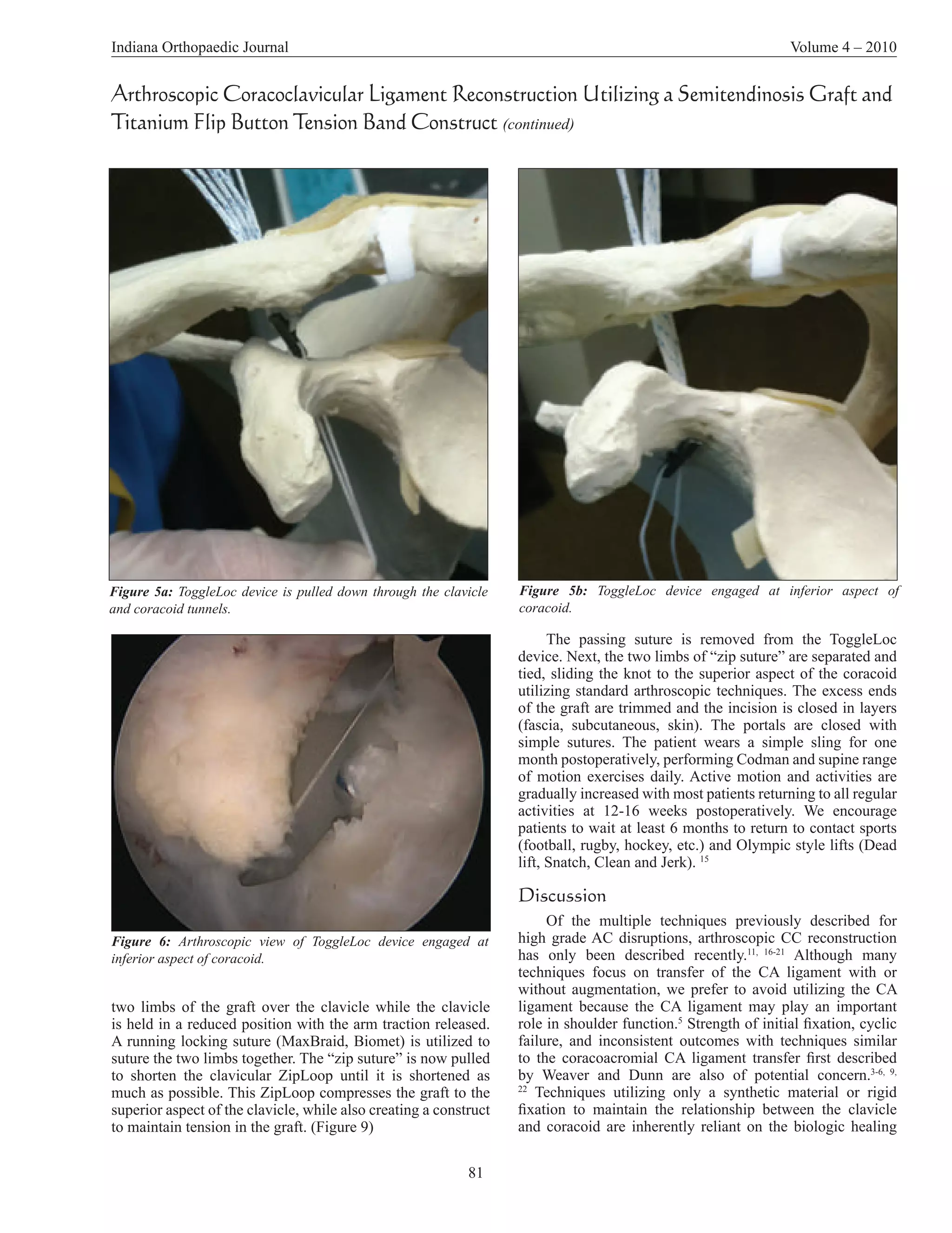 Indiana Orthopaedic Journal                                                                                     Volume 4 – 2010


Arthroscopic Coracoclavicular Ligament Reconstruction Utilizing a Semitendinosis Graft and
Titanium Flip Button Tension Band Construct (continued)




Figure 5a: ToggleLoc device is pulled down through the clavicle    Figure 5b: ToggleLoc device engaged at inferior aspect of
and coracoid tunnels.                                              coracoid.

                                                                         The passing suture is removed from the ToggleLoc
                                                                   device. Next, the two limbs of “zip suture” are separated and
                                                                   tied, sliding the knot to the superior aspect of the coracoid
                                                                   utilizing standard arthroscopic techniques. The excess ends
                                                                   of the graft are trimmed and the incision is closed in layers
                                                                   (fascia, subcutaneous, skin). The portals are closed with
                                                                   simple sutures. The patient wears a simple sling for one
                                                                   month postoperatively, performing Codman and supine range
                                                                   of motion exercises daily. Active motion and activities are
                                                                   gradually increased with most patients returning to all regular
                                                                   activities at 12-16 weeks postoperatively. We encourage
                                                                   patients to wait at least 6 months to return to contact sports
                                                                   (football, rugby, hockey, etc.) and Olympic style lifts (Dead
                                                                   lift, Snatch, Clean and Jerk). 15

                                                                   Discussion
                                                                        Of the multiple techniques previously described for
Figure 6: Arthroscopic view of ToggleLoc device engaged at         high grade AC disruptions, arthroscopic CC reconstruction
inferior aspect of coracoid.                                       has only been described recently.11, 16-21 Although many
                                                                   techniques focus on transfer of the CA ligament with or
                                                                   without augmentation, we prefer to avoid utilizing the CA
two limbs of the graft over the clavicle while the clavicle        ligament because the CA ligament may play an important
is held in a reduced position with the arm traction released.      role in shoulder function.5 Strength of initial fixation, cyclic
A running locking suture (MaxBraid, Biomet) is utilized to         failure, and inconsistent outcomes with techniques similar
suture the two limbs together. The “zip suture” is now pulled      to the coracoacromial CA ligament transfer first described
to shorten the clavicular ZipLoop until it is shortened as         by Weaver and Dunn are also of potential concern.3-6, 9,
much as possible. This ZipLoop compresses the graft to the         22
                                                                      Techniques utilizing only a synthetic material or rigid
superior aspect of the clavicle, while also creating a construct   fixation to maintain the relationship between the clavicle
to maintain tension in the graft. (Figure 9)                       and coracoid are inherently reliant on the biologic healing

                                                            81
 