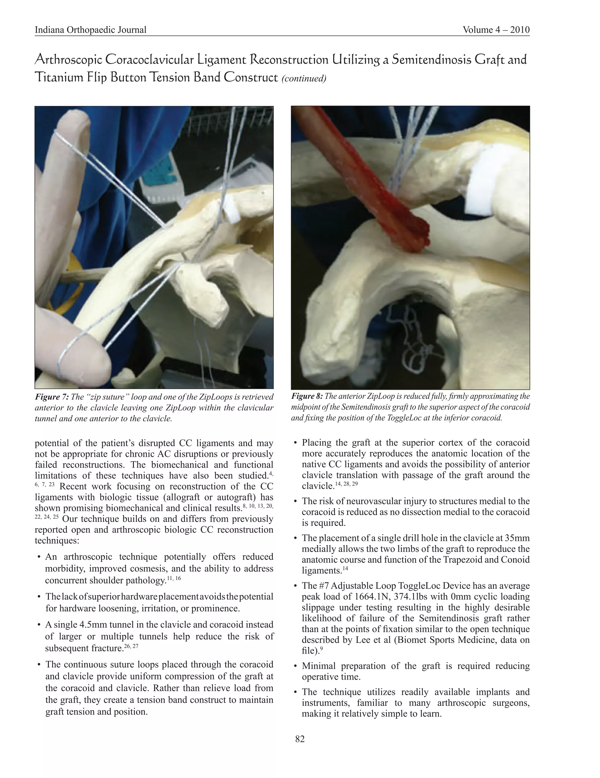 Indiana Orthopaedic Journal                                                                                                 Volume 4 – 2010


Arthroscopic Coracoclavicular Ligament Reconstruction Utilizing a Semitendinosis Graft and
Titanium Flip Button Tension Band Construct (continued)




Figure 7: The “zip suture” loop and one of the ZipLoops is retrieved   Figure 8: The anterior ZipLoop is reduced fully, firmly approximating the
anterior to the clavicle leaving one ZipLoop within the clavicular     midpoint of the Semitendinosis graft to the superior aspect of the coracoid
tunnel and one anterior to the clavicle.                               and fixing the position of the ToggleLoc at the inferior coracoid.

potential of the patient’s disrupted CC ligaments and may              • Placing the graft at the superior cortex of the coracoid
not be appropriate for chronic AC disruptions or previously              more accurately reproduces the anatomic location of the
failed reconstructions. The biomechanical and functional                 native CC ligaments and avoids the possibility of anterior
limitations of these techniques have also been studied.4,                clavicle translation with passage of the graft around the
6, 7, 23
           Recent work focusing on reconstruction of the CC              clavicle.14, 28, 29
ligaments with biologic tissue (allograft or autograft) has            • The risk of neurovascular injury to structures medial to the
shown promising biomechanical and clinical results.8, 10, 13, 20,        coracoid is reduced as no dissection medial to the coracoid
22, 24, 25
           Our technique builds on and differs from previously           is required.
reported open and arthroscopic biologic CC reconstruction
techniques:                                                            • The placement of a single drill hole in the clavicle at 35mm
                                                                         medially allows the two limbs of the graft to reproduce the
• An arthroscopic technique potentially offers reduced                   anatomic course and function of the Trapezoid and Conoid
  morbidity, improved cosmesis, and the ability to address               ligaments.14
  concurrent shoulder pathology.11, 16
                                                                       • The #7 Adjustable Loop ToggleLoc Device has an average
• The lack of superior hardware placement avoids the potential           peak load of 1664.1N, 374.1lbs with 0mm cyclic loading
  for hardware loosening, irritation, or prominence.                     slippage under testing resulting in the highly desirable
                                                                         likelihood of failure of the Semitendinosis graft rather
• A single 4.5mm tunnel in the clavicle and coracoid instead             than at the points of fixation similar to the open technique
  of larger or multiple tunnels help reduce the risk of                  described by Lee et al (Biomet Sports Medicine, data on
  subsequent fracture.26, 27                                             file).9
• The continuous suture loops placed through the coracoid              • Minimal preparation of the graft is required reducing
  and clavicle provide uniform compression of the graft at               operative time.
  the coracoid and clavicle. Rather than relieve load from             • The technique utilizes readily available implants and
  the graft, they create a tension band construct to maintain            instruments, familiar to many arthroscopic surgeons,
  graft tension and position.                                            making it relatively simple to learn.

                                                                        82
 