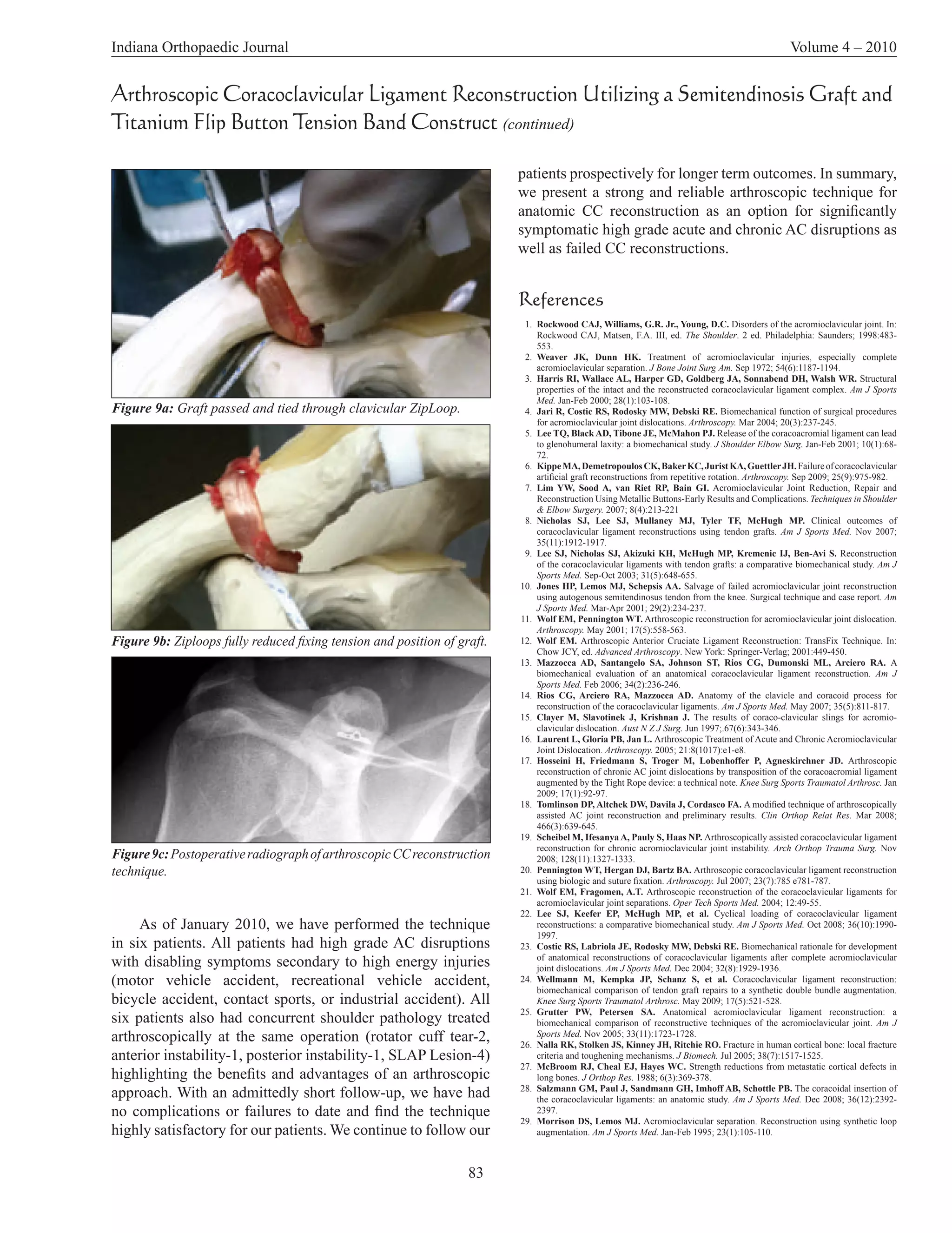 Indiana Orthopaedic Journal                                                                                                                      Volume 4 – 2010


Arthroscopic Coracoclavicular Ligament Reconstruction Utilizing a Semitendinosis Graft and
Titanium Flip Button Tension Band Construct (continued)

                                                                          patients prospectively for longer term outcomes. In summary,
                                                                          we present a strong and reliable arthroscopic technique for
                                                                          anatomic CC reconstruction as an option for significantly
                                                                          symptomatic high grade acute and chronic AC disruptions as
                                                                          well as failed CC reconstructions.


                                                                          References
                                                                           1. Rockwood CAJ, Williams, G.R. Jr., Young, D.C. Disorders of the acromioclavicular joint. In:
                                                                              Rockwood CAJ, Matsen, F.A. III, ed. The Shoulder. 2 ed. Philadelphia: Saunders; 1998:483-
                                                                              553.
                                                                           2. Weaver JK, Dunn HK. Treatment of acromioclavicular injuries, especially complete
                                                                              acromioclavicular separation. J Bone Joint Surg Am. Sep 1972; 54(6):1187-1194.
                                                                           3. Harris RI, Wallace AL, Harper GD, Goldberg JA, Sonnabend DH, Walsh WR. Structural
                                                                              properties of the intact and the reconstructed coracoclavicular ligament complex. Am J Sports
                                                                              Med. Jan-Feb 2000; 28(1):103-108.
Figure 9a: Graft passed and tied through clavicular ZipLoop.               4. Jari R, Costic RS, Rodosky MW, Debski RE. Biomechanical function of surgical procedures
                                                                              for acromioclavicular joint dislocations. Arthroscopy. Mar 2004; 20(3):237-245.
                                                                           5. Lee TQ, Black AD, Tibone JE, McMahon PJ. Release of the coracoacromial ligament can lead
                                                                              to glenohumeral laxity: a biomechanical study. J Shoulder Elbow Surg. Jan-Feb 2001; 10(1):68-
                                                                              72.
                                                                           6. Kippe MA, Demetropoulos CK, Baker KC, Jurist KA, Guettler JH. Failure of coracoclavicular
                                                                              artificial graft reconstructions from repetitive rotation. Arthroscopy. Sep 2009; 25(9):975-982.
                                                                           7. Lim YW, Sood A, van Riet RP, Bain GI. Acromioclavicular Joint Reduction, Repair and
                                                                              Reconstruction Using Metallic Buttons-Early Results and Complications. Techniques in Shoulder
                                                                              & Elbow Surgery. 2007; 8(4):213-221
                                                                           8. Nicholas SJ, Lee SJ, Mullaney MJ, Tyler TF, McHugh MP. Clinical outcomes of
                                                                              coracoclavicular ligament reconstructions using tendon grafts. Am J Sports Med. Nov 2007;
                                                                              35(11):1912-1917.
                                                                           9. Lee SJ, Nicholas SJ, Akizuki KH, McHugh MP, Kremenic IJ, Ben-Avi S. Reconstruction
                                                                              of the coracoclavicular ligaments with tendon grafts: a comparative biomechanical study. Am J
                                                                              Sports Med. Sep-Oct 2003; 31(5):648-655.
                                                                          10. Jones HP, Lemos MJ, Schepsis AA. Salvage of failed acromioclavicular joint reconstruction
                                                                              using autogenous semitendinosus tendon from the knee. Surgical technique and case report. Am
                                                                              J Sports Med. Mar-Apr 2001; 29(2):234-237.
                                                                          11. Wolf EM, Pennington WT. Arthroscopic reconstruction for acromioclavicular joint dislocation.
                                                                              Arthroscopy. May 2001; 17(5):558-563.
Figure 9b: Ziploops fully reduced fixing tension and position of graft.   12. Wolf EM. Arthroscopic Anterior Cruciate Ligament Reconstruction: TransFix Technique. In:
                                                                              Chow JCY, ed. Advanced Arthroscopy. New York: Springer-Verlag; 2001:449-450.
                                                                          13. Mazzocca AD, Santangelo SA, Johnson ST, Rios CG, Dumonski ML, Arciero RA. A
                                                                              biomechanical evaluation of an anatomical coracoclavicular ligament reconstruction. Am J
                                                                              Sports Med. Feb 2006; 34(2):236-246.
                                                                          14. Rios CG, Arciero RA, Mazzocca AD. Anatomy of the clavicle and coracoid process for
                                                                              reconstruction of the coracoclavicular ligaments. Am J Sports Med. May 2007; 35(5):811-817.
                                                                          15. Clayer M, Slavotinek J, Krishnan J. The results of coraco-clavicular slings for acromio-
                                                                              clavicular dislocation. Aust N Z J Surg. Jun 1997;.67(6):343-346.
                                                                          16. Laurent L, Gloria PB, Jan L. Arthroscopic Treatment of Acute and Chronic Acromioclavicular
                                                                              Joint Dislocation. Arthroscopy. 2005; 21:8(1017):e1-e8.
                                                                          17. Hosseini H, Friedmann S, Troger M, Lobenhoffer P, Agneskirchner JD. Arthroscopic
                                                                              reconstruction of chronic AC joint dislocations by transposition of the coracoacromial ligament
                                                                              augmented by the Tight Rope device: a technical note. Knee Surg Sports Traumatol Arthrosc. Jan
                                                                              2009; 17(1):92-97.
                                                                          18. Tomlinson DP, Altchek DW, Davila J, Cordasco FA. A modified technique of arthroscopically
                                                                              assisted AC joint reconstruction and preliminary results. Clin Orthop Relat Res. Mar 2008;
                                                                              466(3):639-645.
                                                                          19. Scheibel M, Ifesanya A, Pauly S, Haas NP. Arthroscopically assisted coracoclavicular ligament
                                                                              reconstruction for chronic acromioclavicular joint instability. Arch Orthop Trauma Surg. Nov
Figure 9c: Postoperative radiograph of arthroscopic CC reconstruction         2008; 128(11):1327-1333.
technique.                                                                20. Pennington WT, Hergan DJ, Bartz BA. Arthroscopic coracoclavicular ligament reconstruction
                                                                              using biologic and suture fixation. Arthroscopy. Jul 2007; 23(7):785 e781-787.
                                                                          21. Wolf EM, Fragomen, A.T. Arthroscopic reconstruction of the coracoclavicular ligaments for
                                                                              acromioclavicular joint separations. Oper Tech Sports Med. 2004; 12:49-55.
                                                                          22. Lee SJ, Keefer EP, McHugh MP, et al. Cyclical loading of coracoclavicular ligament
     As of January 2010, we have performed the technique                      reconstructions: a comparative biomechanical study. Am J Sports Med. Oct 2008; 36(10):1990-
                                                                              1997.
in six patients. All patients had high grade AC disruptions               23. Costic RS, Labriola JE, Rodosky MW, Debski RE. Biomechanical rationale for development
with disabling symptoms secondary to high energy injuries                     of anatomical reconstructions of coracoclavicular ligaments after complete acromioclavicular
                                                                              joint dislocations. Am J Sports Med. Dec 2004; 32(8):1929-1936.
(motor vehicle accident, recreational vehicle accident,                   24. Wellmann M, Kempka JP, Schanz S, et al. Coracoclavicular ligament reconstruction:
                                                                              biomechanical comparison of tendon graft repairs to a synthetic double bundle augmentation.
bicycle accident, contact sports, or industrial accident). All                Knee Surg Sports Traumatol Arthrosc. May 2009; 17(5):521-528.
                                                                          25. Grutter PW, Petersen SA. Anatomical acromioclavicular ligament reconstruction: a
six patients also had concurrent shoulder pathology treated                   biomechanical comparison of reconstructive techniques of the acromioclavicular joint. Am J
arthroscopically at the same operation (rotator cuff tear-2,                  Sports Med. Nov 2005; 33(11):1723-1728.
                                                                          26. Nalla RK, Stolken JS, Kinney JH, Ritchie RO. Fracture in human cortical bone: local fracture
anterior instability-1, posterior instability-1, SLAP Lesion-4)               criteria and toughening mechanisms. J Biomech. Jul 2005; 38(7):1517-1525.
                                                                          27. McBroom RJ, Cheal EJ, Hayes WC. Strength reductions from metastatic cortical defects in
highlighting the benefits and advantages of an arthroscopic                   long bones. J Orthop Res. 1988; 6(3):369-378.
approach. With an admittedly short follow-up, we have had                 28. Salzmann GM, Paul J, Sandmann GH, Imhoff AB, Schottle PB. The coracoidal insertion of
                                                                              the coracoclavicular ligaments: an anatomic study. Am J Sports Med. Dec 2008; 36(12):2392-
no complications or failures to date and find the technique                   2397.
                                                                          29. Morrison DS, Lemos MJ. Acromioclavicular separation. Reconstruction using synthetic loop
highly satisfactory for our patients. We continue to follow our               augmentation. Am J Sports Med. Jan-Feb 1995; 23(1):105-110.



                                                                   83
 