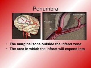 Penumbra
• The marginal zone outside the infarct zone
• The area in which the infarct will expand into
 