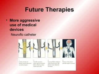 Future Therapies
• More aggressive
use of medical
devices
Neuroflo catheter
 