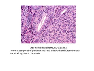 Academic review - Endometriod Adenocarcinoma | PPTX