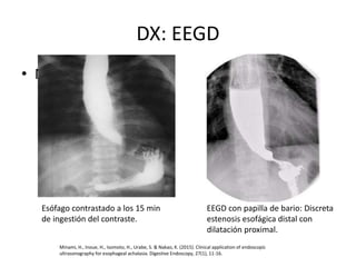 DX: EEGD
• N b
Esófago contrastado a los 15 min
de ingestión del contraste.
EEGD con papilla de bario: Discreta
estenosis esofágica distal con
dilatación proximal.
Minami, H., Inoue, H., Isomoto, H., Urabe, S. & Nakao, K. (2015). Clinical application of endoscopic
ultrasonography for esophageal achalasia. Digestive Endoscopy, 27(1), 11-16.
 