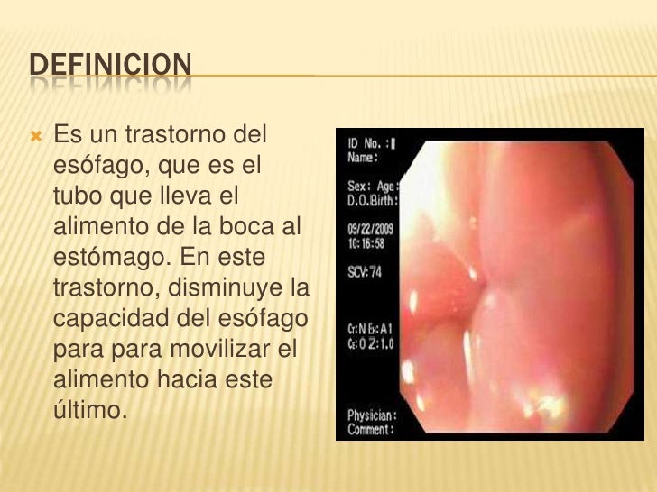 Acalasia.pptx pq ii dr. de la cruz