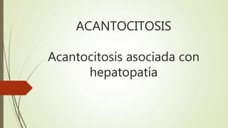 ACANTOCITOSIS
Acantocitosis asociada con
hepatopatía
 