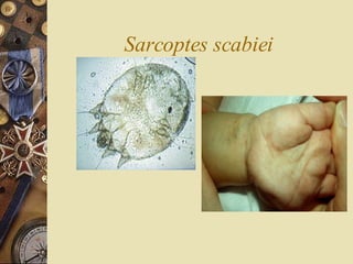 Sarcoptes scabiei 
