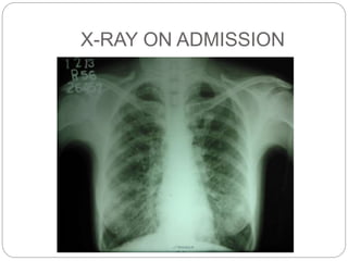 A CASE OF ABPA (1).pptx