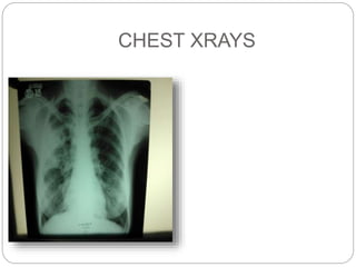 A CASE OF ABPA (1).pptx
