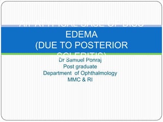 An ATYPICAL CASE OF DISC
EDEMA
(DUE TO POSTERIOR
SCLERITIS)
Dr Samuel Ponraj
Post graduate
Department of Ophthalmology
MMC & RI

 