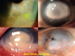 BACTERIAL ULCERS
 