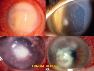 A)Severe candidal keratitis;
here is a large epithelial defect, and folds in Descemet membrane
FUNGAL ULCERS
 