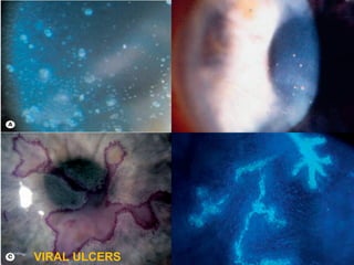 VIRAL ULCERS
VIRAL ULCERS
 