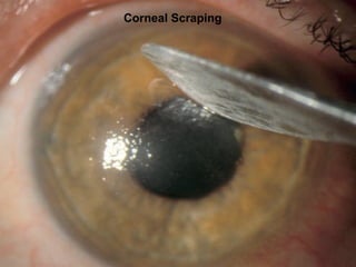 Corneal Scraping
 