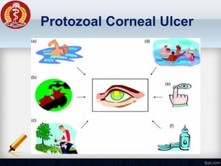 Protozoal Corneal Ulcer
 