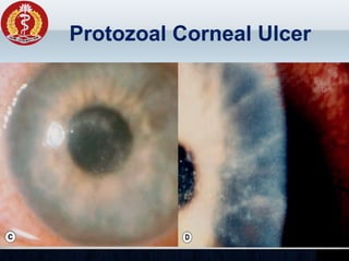 Protozoal Corneal Ulcer
 