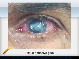 Tissue adhesive glue
 