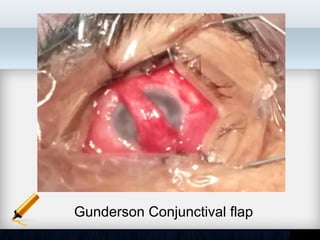 Gunderson Conjunctival flap
 