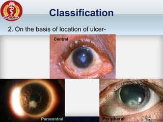 Classification
2. On the basis of location of ulcer-
Central
Paracentral Peripheral
 