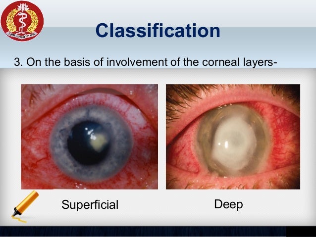 corneal ulcer corneal ulcer