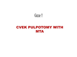 Case 1
CVEK PULPOTOMY WITH
MTA
 